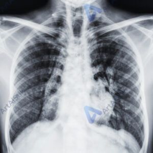 Рентгеновский снимок лёгких на световом экране.